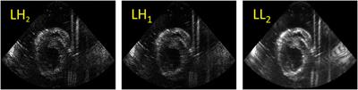 Cardiac Strain Imaging Using Multi-Perspective Ultrafast Ultrasound